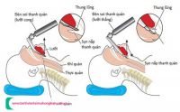 TÌM HIỂU ĐẶT ỐNG NỘI KHÍ QUẢN ĐƯỜNG MIỆNG KHI GÂY MÊ BỆNH NHÂN