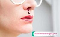 Hướng dẫn cách xử lý khi chảy máu mũi