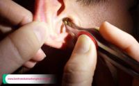 Tìm hiểu phương pháp phẫu thuật viêm tai giữa có cholesteatoma