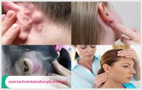 Nổi hạch sau tai là bệnh gì?