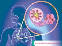 [TPHCM] Đợt cấp COPD là bệnh gì
