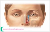 Viêm mũi có ảnh hưởng đến mắt không