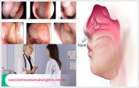 Các giai đoạn của viêm xoang polyp mũi và cách điều trị