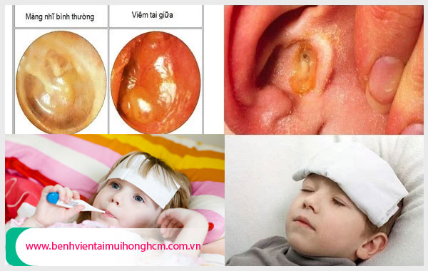 Bệnh viêm tai giữa ở trẻ em - cần cảnh giác và điều trị sớm nhất