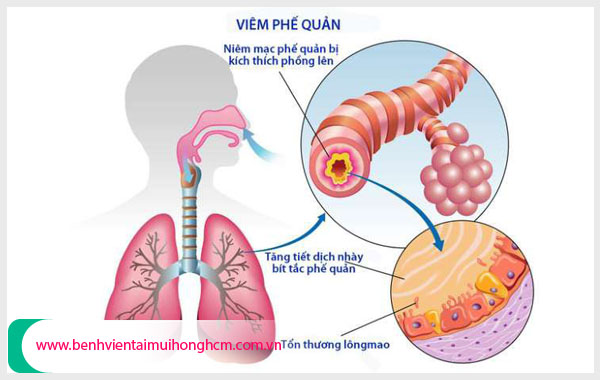 Viêm phổi - Phế quản