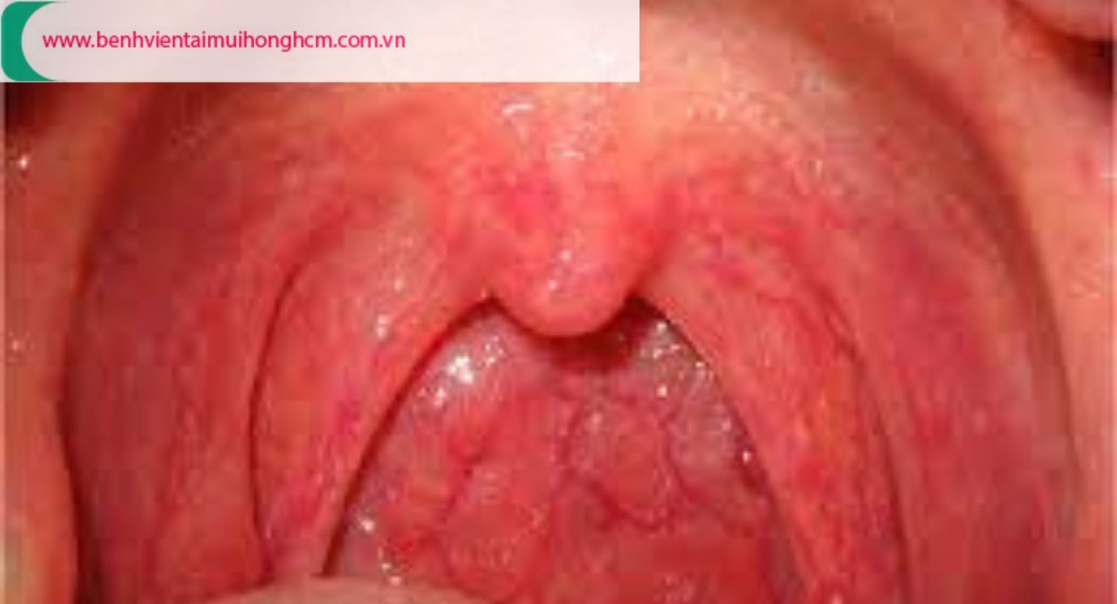 Phân biệt hình ảnh viêm họng hạt - họng bình thường