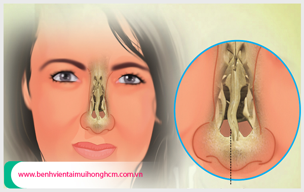 Tìm hiểu sâu về vẹo vách ngăn mũi Phong-kham-da-khoa-hoan-cau-ly-giai-veo-vach-ngan-mui-648-1