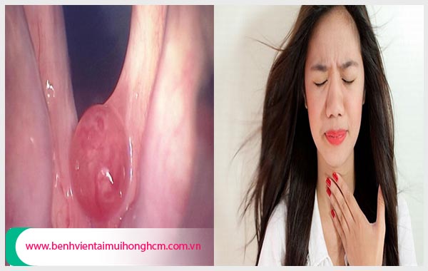 Có nhiều người thắc mắc polyp thanh quản là gì