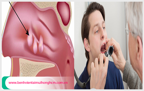 Cần sớm chữa bệnh polyp vòm họng