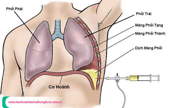 tràn dịch màng phổi là gì