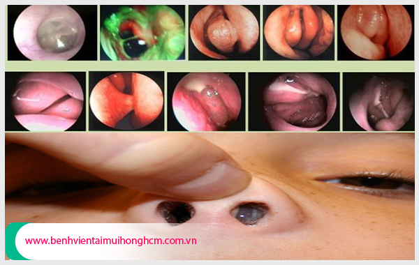 Có nhiều giai đoạn bệnh viêm xoang polyp ở mũi