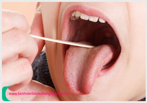 Vệ sinh vòm họng sạch sẽ thường xuyên để khắc phục họng nổi hạt